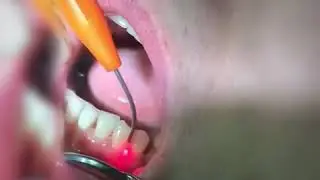 Лазерная стоматология. Стерилизация карманов, лечение дёсен