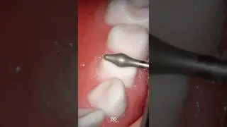 Step-by-step tooth preparation: How to create horizontal space with the BOPT concept. 