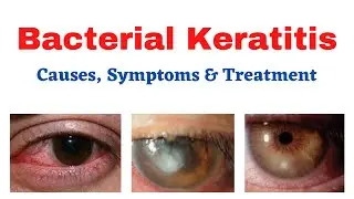 Bacterial Keratitis | Bacterial Keratitis Causes | Bacterial Keratitis Treatment