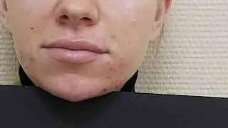 Коррекция подбородка филлером.