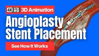Angioplasty and Stent Placements - See How It Works - 4K 3D Animation