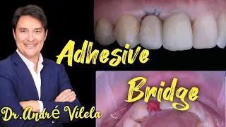 Adhesive bridge. Composite restoration. Dr. André Vilela.
