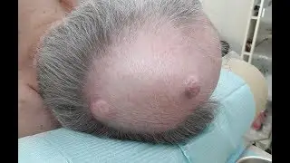 Удаление двух жировиков (атером) на голове
