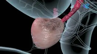 El diagnóstico precoz también es importante para la curación del cáncer de próstata