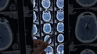 Vp shunt look hyperdense on CT brain