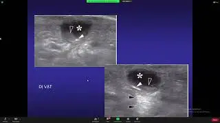 Siêu âm cơ quan vận động - PGS. TS. BS. Bùi Văn Giang
