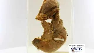 Pancreas: Ductal adenocarcinoma