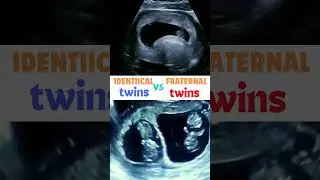 Identical v Fraternal twins ! identify? #baby #pregnancy #ultrasound #shorts