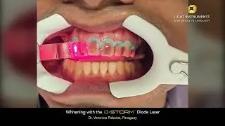 Whitening with the D-Storm™ Diode Laser