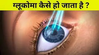 Glaucoma (काली मोतिया) कैसे होता है ?