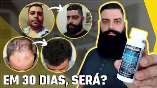 MINOXIDIL: Resultados SURPREENDENTES em apenas 30 dias? CUIDADO Não Seja ENGANADO!