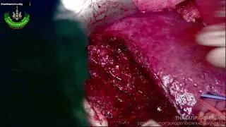 Anatomical Segmentectomy S6 and Subsegmentectomy S5