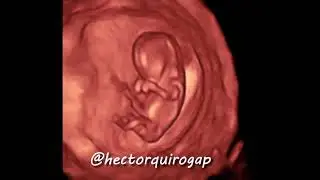 3D ultrasound at 11 weeks of pregnancy