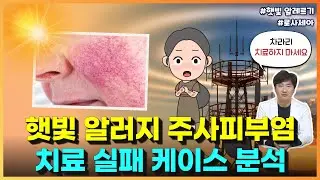 햇빛 알러지 주사피부염 로사세아 : 치료 실패 케이스 분석