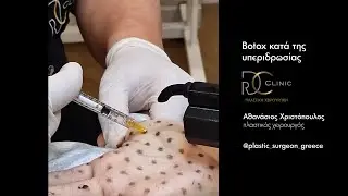 Υπεριδρωσία αντιμετώπιση με botox