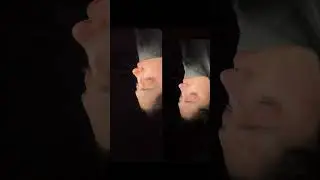 4th Revision Rhinoplasty with Costal Cartilage: Before and After