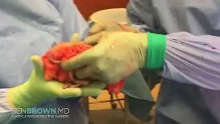 Dr. Benjamin Brown, Plastic Surgeon - Breast Reduction with Superomedial Pedicle