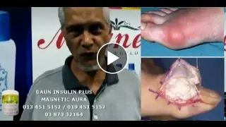 GOUT SEMBUH BENGKAK HILANG LEPAS GUNA DAUN INSULIN PLUS MAGNETIC AURA