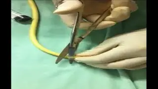How to use a standard Foley-catheter for Bladder irrigation/drainage if unavailable 3-ways catheter