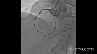 Comparison of outcomes between single long stent and overlapping stents