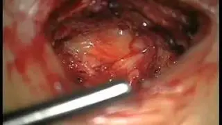 Операция. Удаление грыжи межпозвонкового диска. Нейрохирургия. 18+