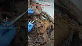 El ligamento redondo o terete del hígado