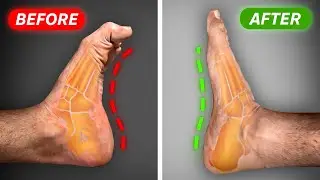Fix High Arches & Supinated Feet FAST (in 30 Days)