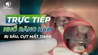 Direct extraction of decayed molars with only the root remaining