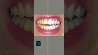 Easy way to Whiten Teeth | Photoshop Tutorial | 