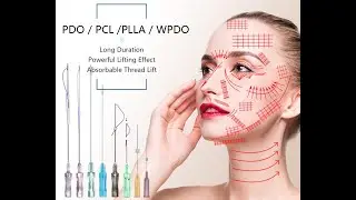 Treating Double Chin Using PDO Twisted Threads