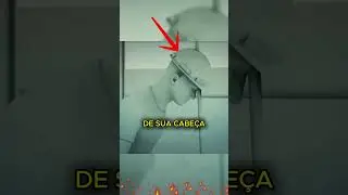 TEVE CABEÇA PERFURADA E SOBREVIVEU! #curioso #incrível #interessante #shorts #bizarro