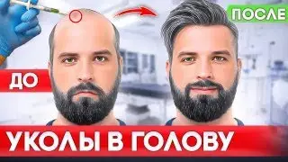 КОСМЕТОЛОГИЯ И ВОЛОСЫ | ПРП МЕЗОТЕРАПИЯ ДЕРМАРОЛЛЕР ПОМОГАЮТ? | ВЫПАДЕНИЕ ВОЛОС