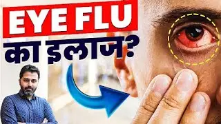 Eye Flu : Conjunctivitis आई फ्लू क्यों होता है , इससे कैसे बचें ? | आई फ्लू (Eye Flu ) का इलाज