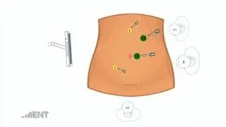 COMPLETE MESOCOLON EXCISION GUIDED BY INDOCYANINE GREEN FOR RIGHT COLONIC CANCER