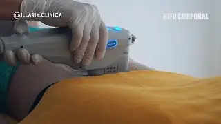 Hifu corporal para eliminar la grasa localizada