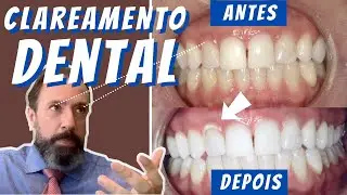 TIPOS de Clareamento Dental⎮Receita para CLAREAR os DENTES