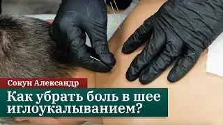 How to relieve neck pain with dry needling? Alexander Sokun