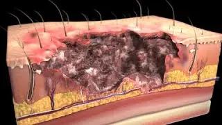 Quemaduras: Clasificación y Tratamiento