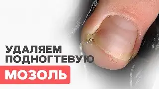 TOENAIL callus | How to remove it?