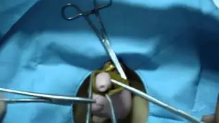 Circumcision - Clinical Skills Lab - Doctor Demonstration (in Indonesian language)