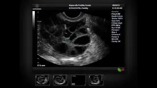 IVF egg retrieval