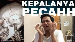HATI-HATI DI JALAN SUPAYA TIDAK SEPERTI DI VIDEO/ CT SCAN 3D  KEPALA