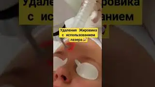 Удаления липом с помощью лазера #здоровье #здоровьеидолголетие #медицина #заздоровье #лайфхаки