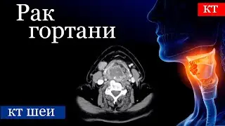 Лучевая диагностика рака гортани