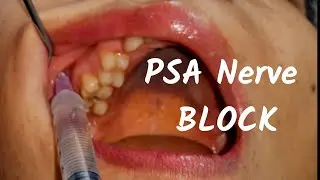 Posterior Superior nerve Block (PSA) Inj in #dentistry  Landmark & Technique in Dental Teeth Surgery