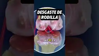 Gonartrosis