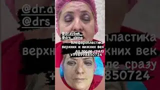 Блефаропластика верхних и нижних век до после сразу гарантия на результат +998998850724