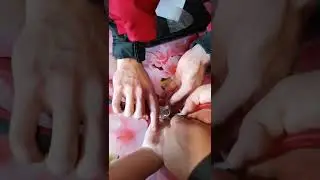 Спасатели сняли кольцо с опухшего пальца #Shorts