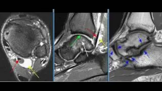 MRI Ankle Case 07
