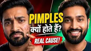 Why Pimples only on Face | ज्यादा फुंसी फोड़े चेहरे पर ही क्यों होते है ? #pimples #acne #blackheads